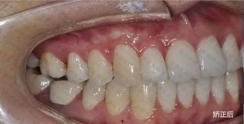 不拔牙矫正成人案例视频,见证牙齿矫正新篇章